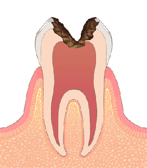 C3むし歯