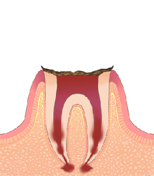 C4むし歯