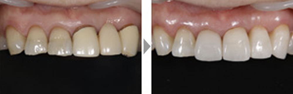 不良補綴の審美的な再治療の症例