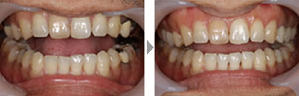 天然の歯に寄せたノンメタル治療の症例