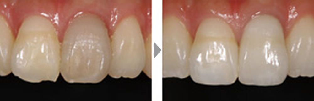 周囲の歯との調和を目指した審美治療の症例