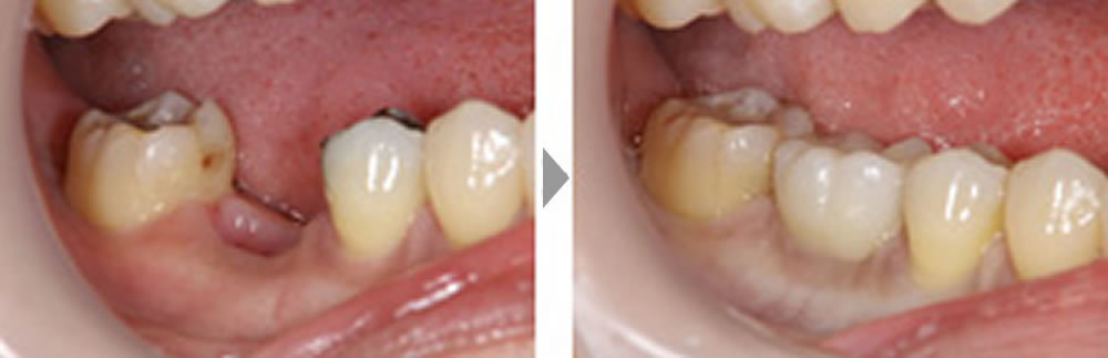臼歯部のインプラント治療の症例