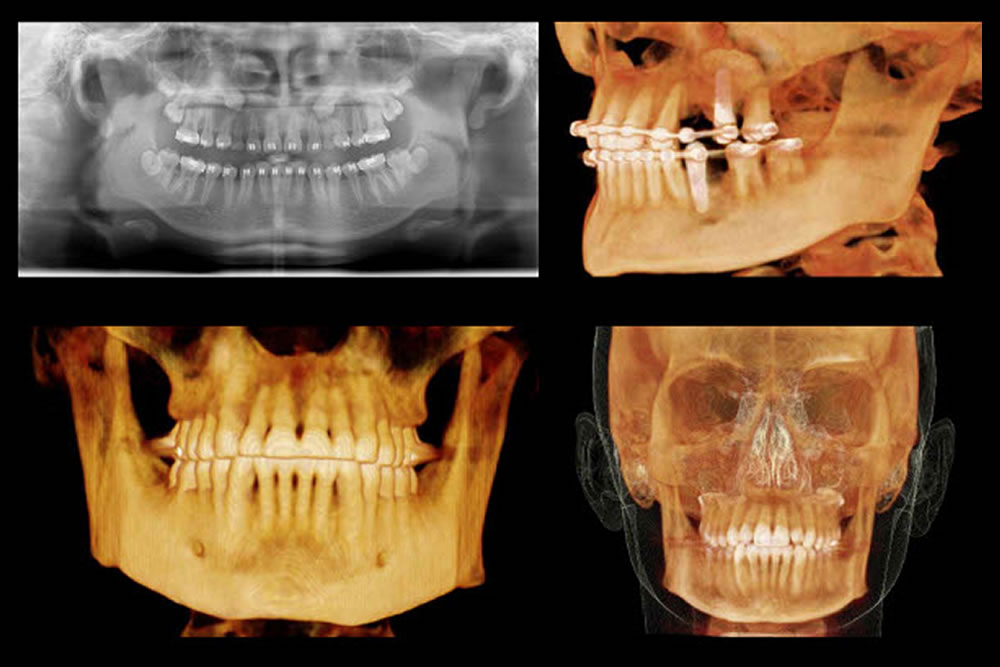 歯科用CTによる検査