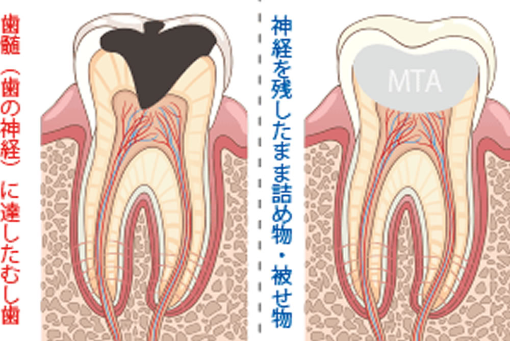 歯髄温存療法（VPT）