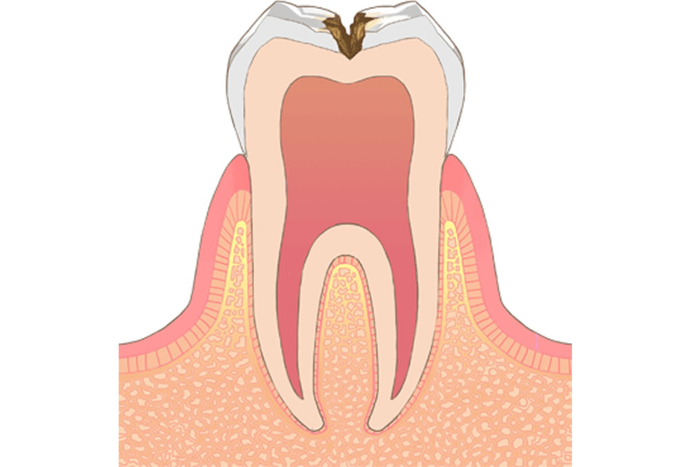 象牙質の虫歯（C2）