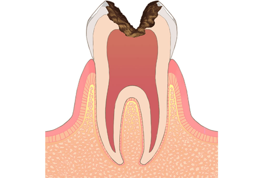 神経にまで達した虫歯（C3）