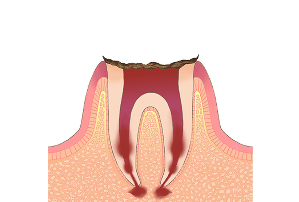 歯がほとんど残っていない歯の虫歯（C4）