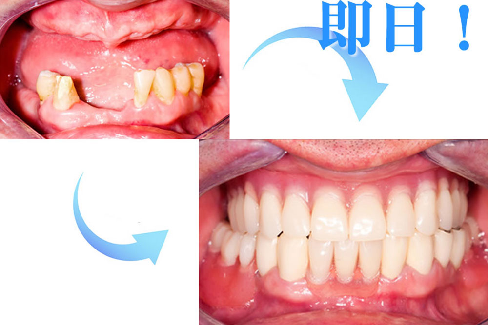 抜歯即時インプラント