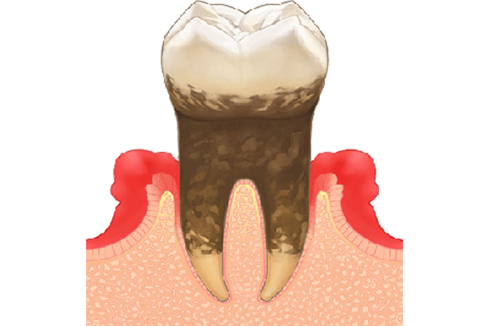 重度歯周病