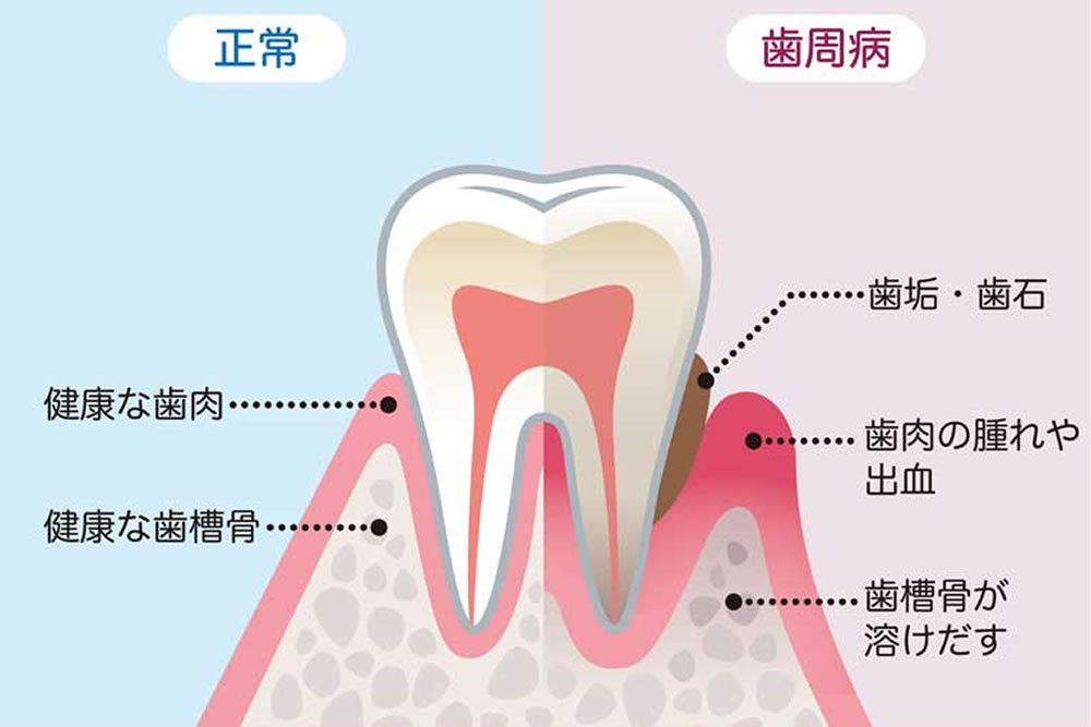 歯周病治療