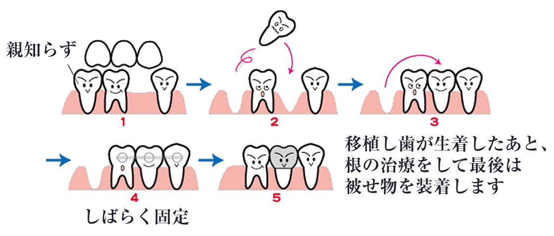 歯牙移植等